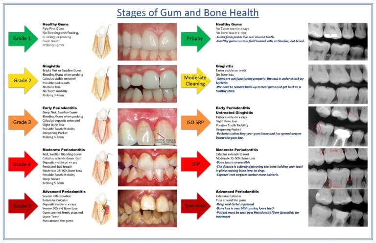 Teeth Cleaning Atlanta - Checkups, Cleanings, & Hygiene | Dental TLC