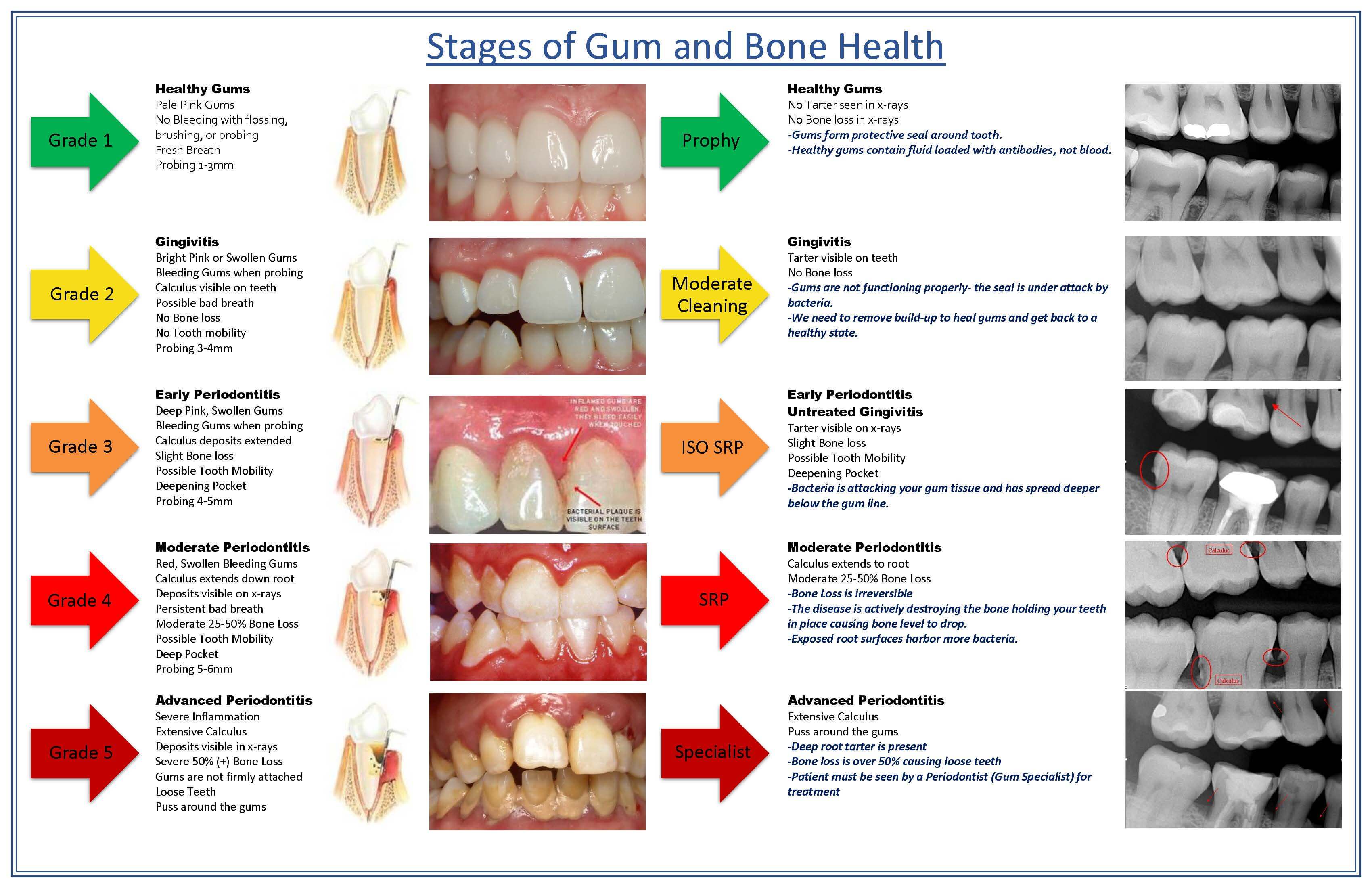 Dtlc Stages Of Gum And Bone Health Dental Tlc